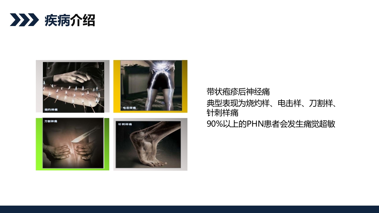 带状疱疹后遗神经痛护理查房PPT课件9