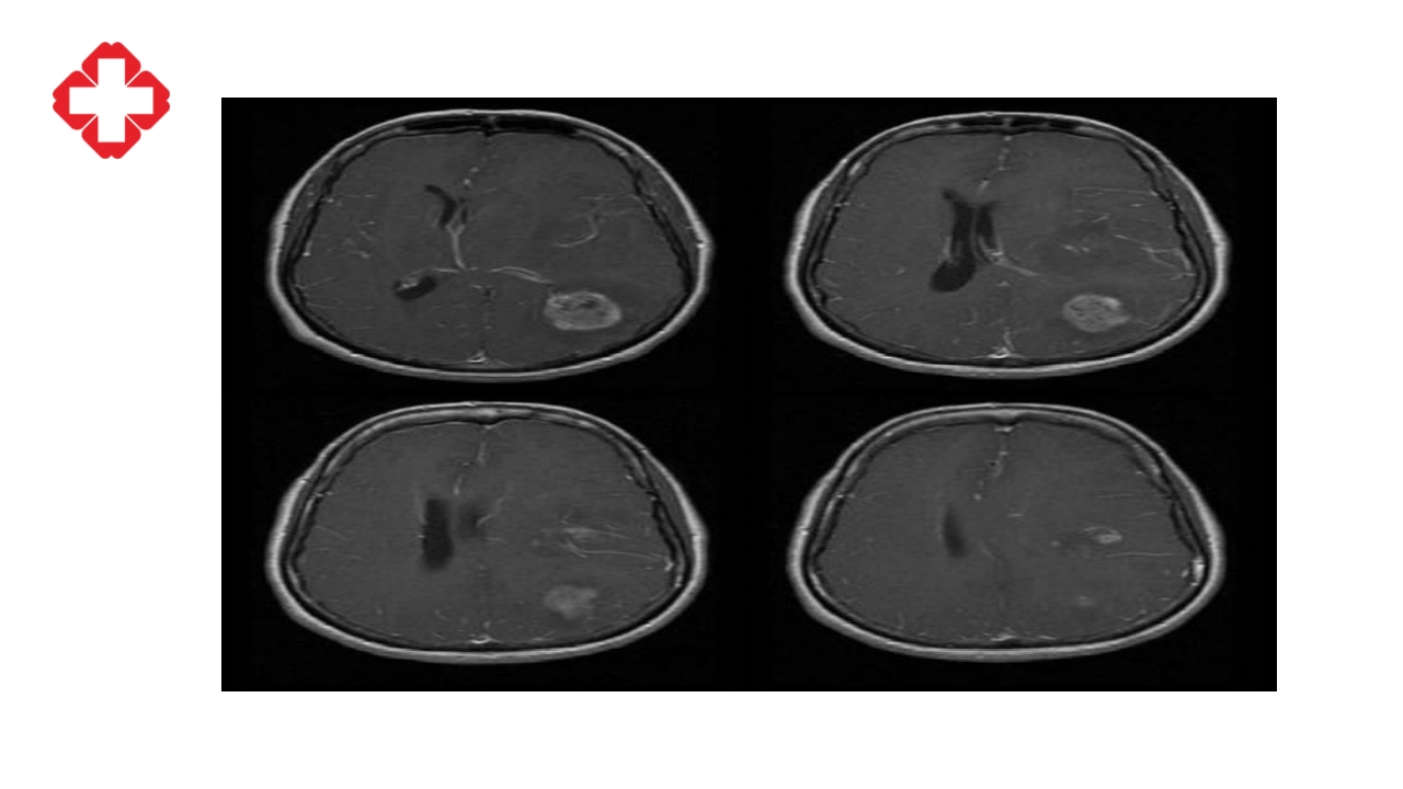 神经外科手术配合ppt大脑半球胶质瘤PPT课件13