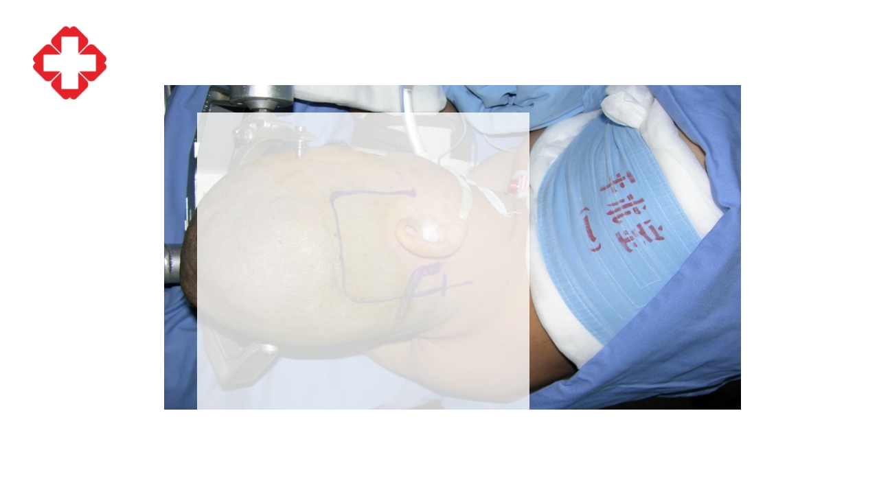 神经外科手术配合ppt大脑半球胶质瘤PPT课件24