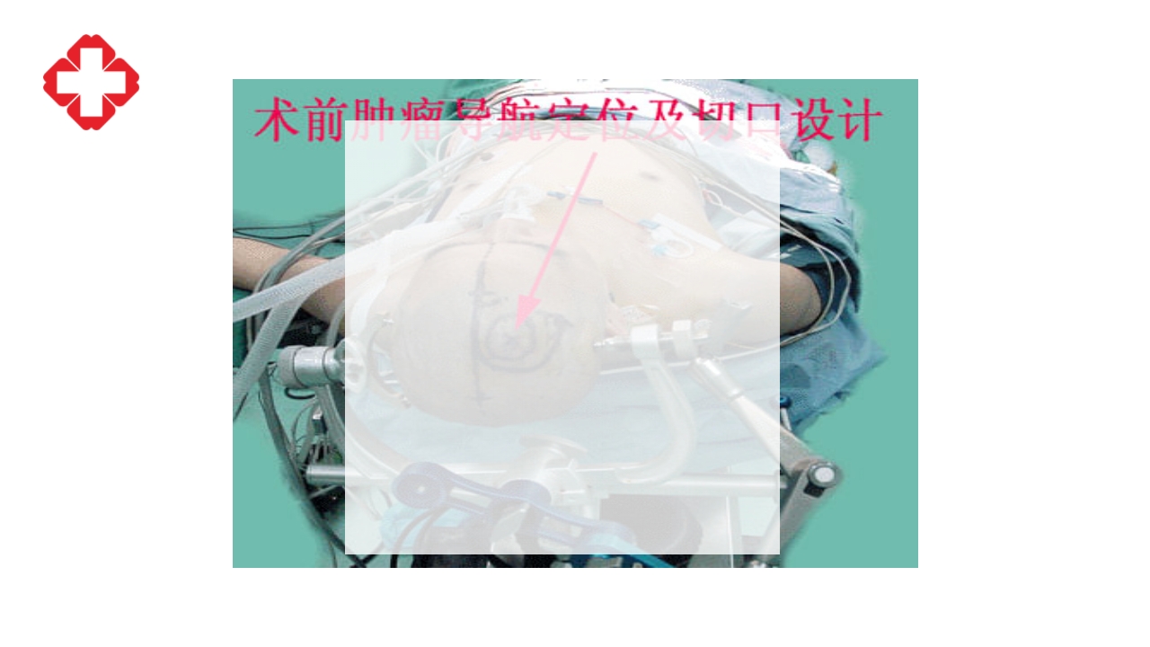 神经外科手术配合ppt大脑半球胶质瘤PPT课件27