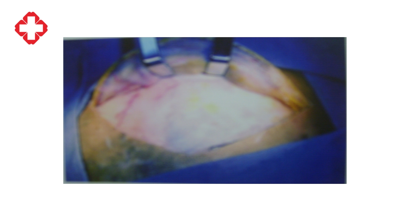 神经外科手术配合ppt大脑半球胶质瘤PPT课件35