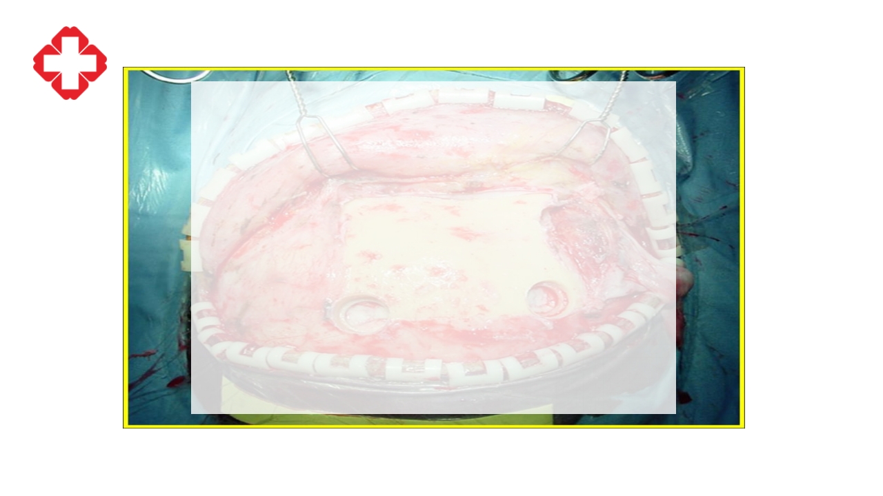 神经外科手术配合ppt大脑半球胶质瘤PPT课件36