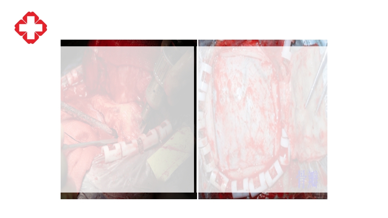 神经外科手术配合ppt大脑半球胶质瘤PPT课件38