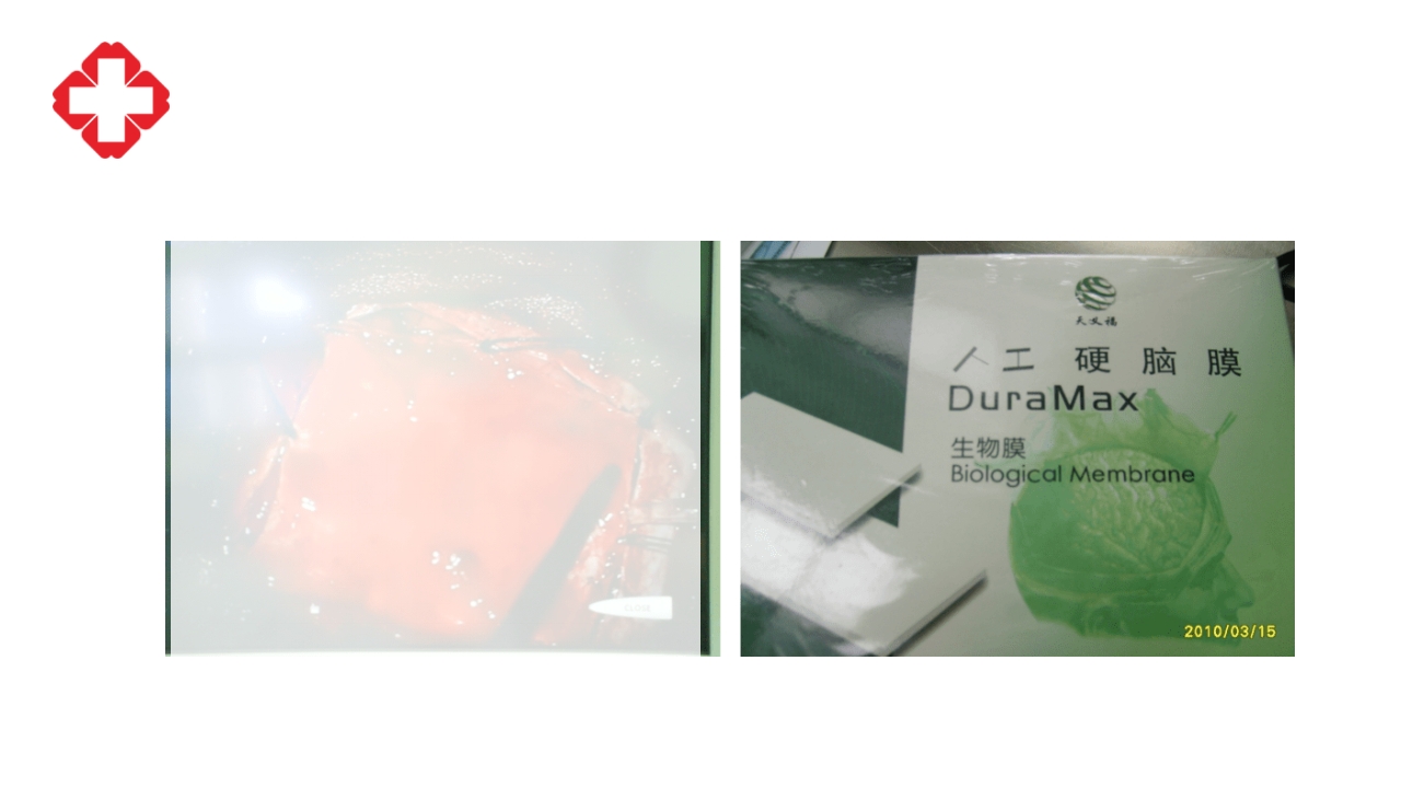 神经外科手术配合ppt大脑半球胶质瘤PPT课件50