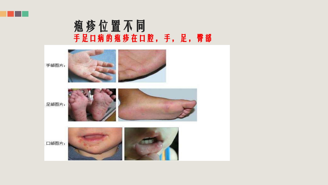 疱疹性咽峡炎的管理和中医药治疗PPT课件11