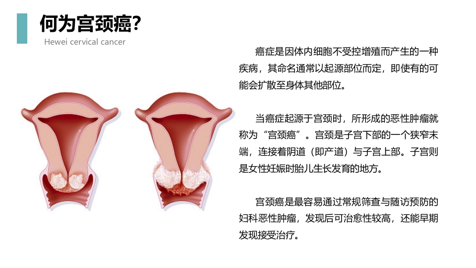 宫颈癌科普知识PPT课件4