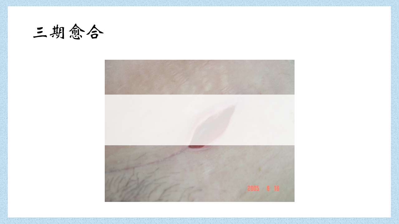 外科常见伤口换药技术PPT课件18