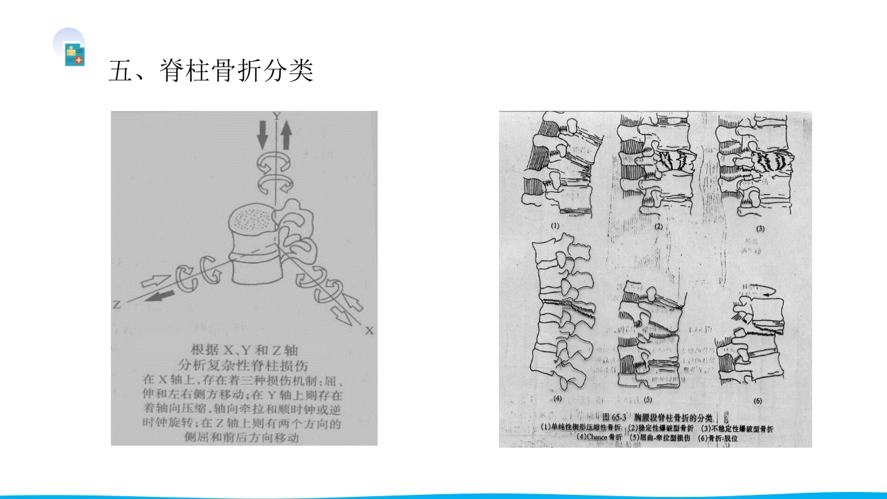脊柱骨折与脊髓损伤PPT课件下载11