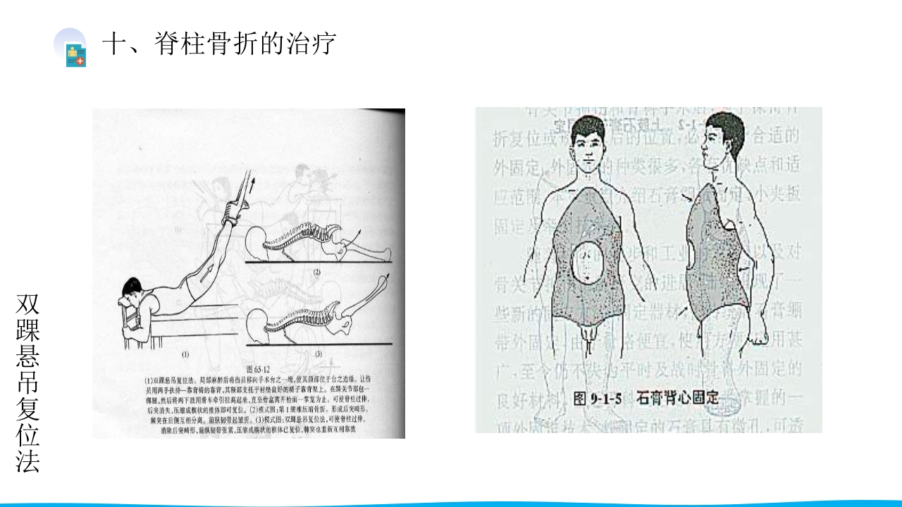 脊柱骨折与脊髓损伤PPT课件下载22