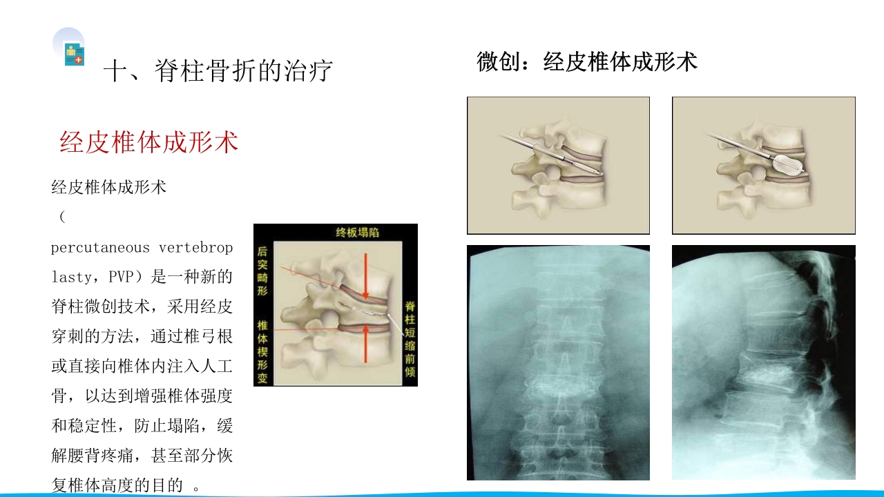 脊柱骨折与脊髓损伤PPT课件下载24
