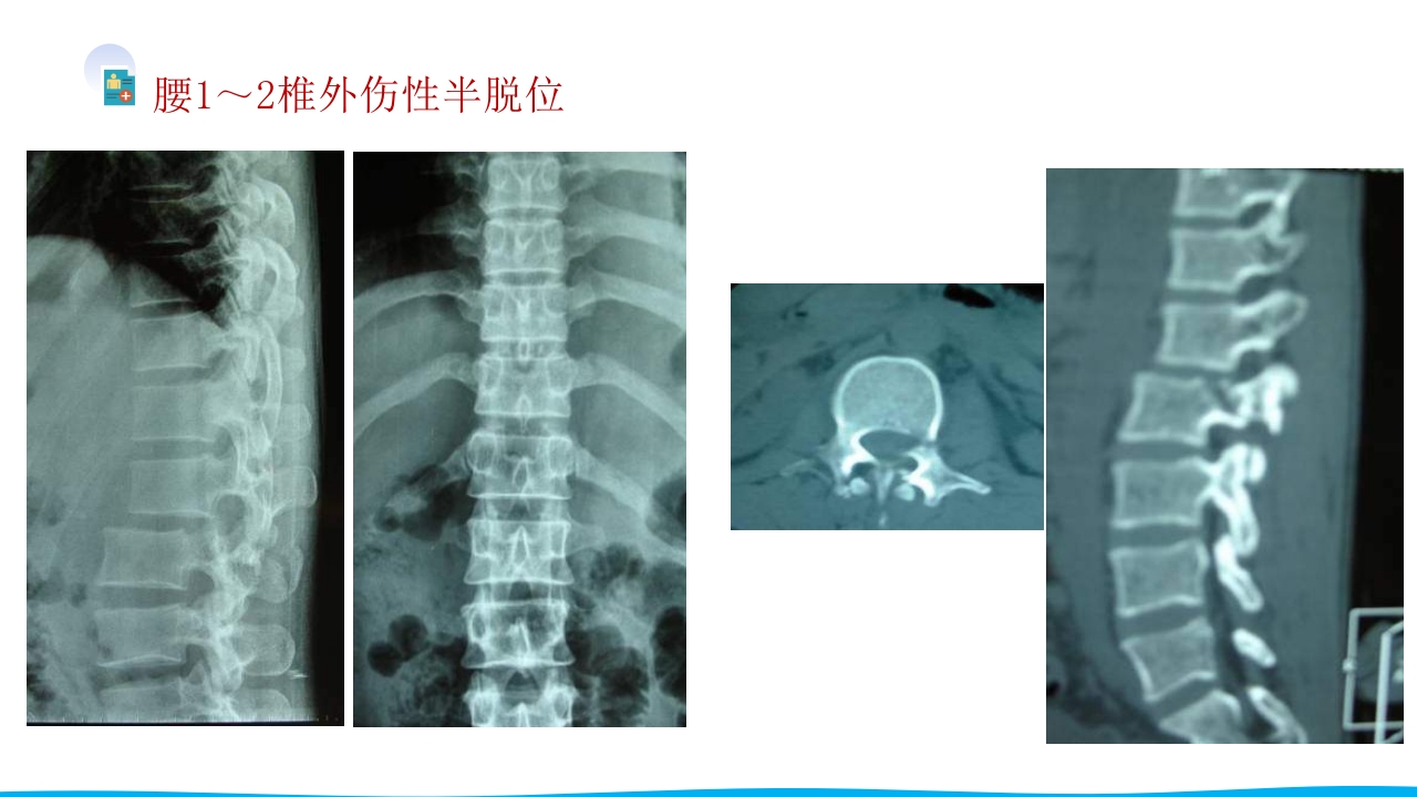 脊柱骨折与脊髓损伤PPT课件下载27