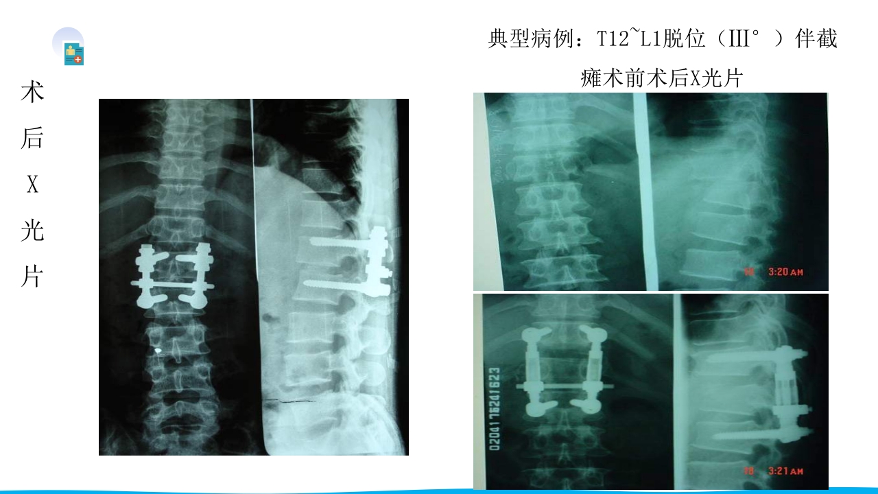 脊柱骨折与脊髓损伤PPT课件下载28