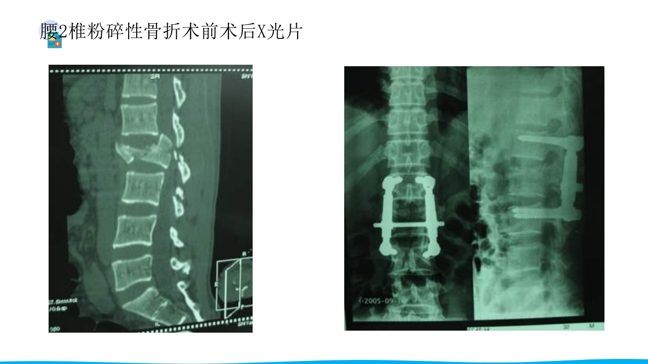 脊柱骨折与脊髓损伤PPT课件下载29