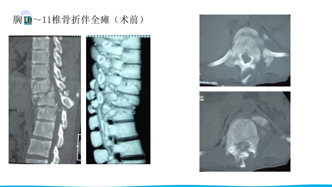 脊柱骨折与脊髓损伤PPT课件下载30