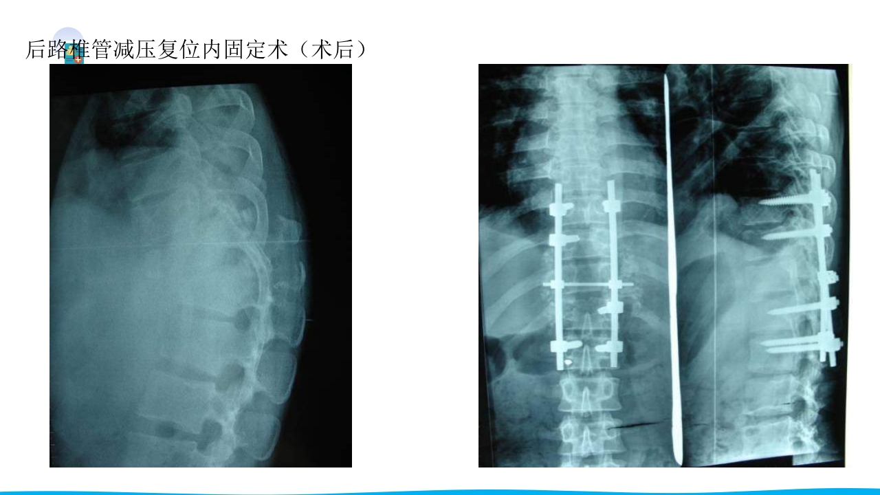 脊柱骨折与脊髓损伤PPT课件下载31
