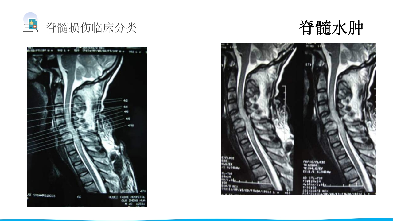 脊柱骨折与脊髓损伤PPT课件下载38