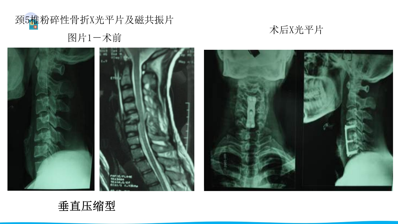 脊柱骨折与脊髓损伤PPT课件下载55