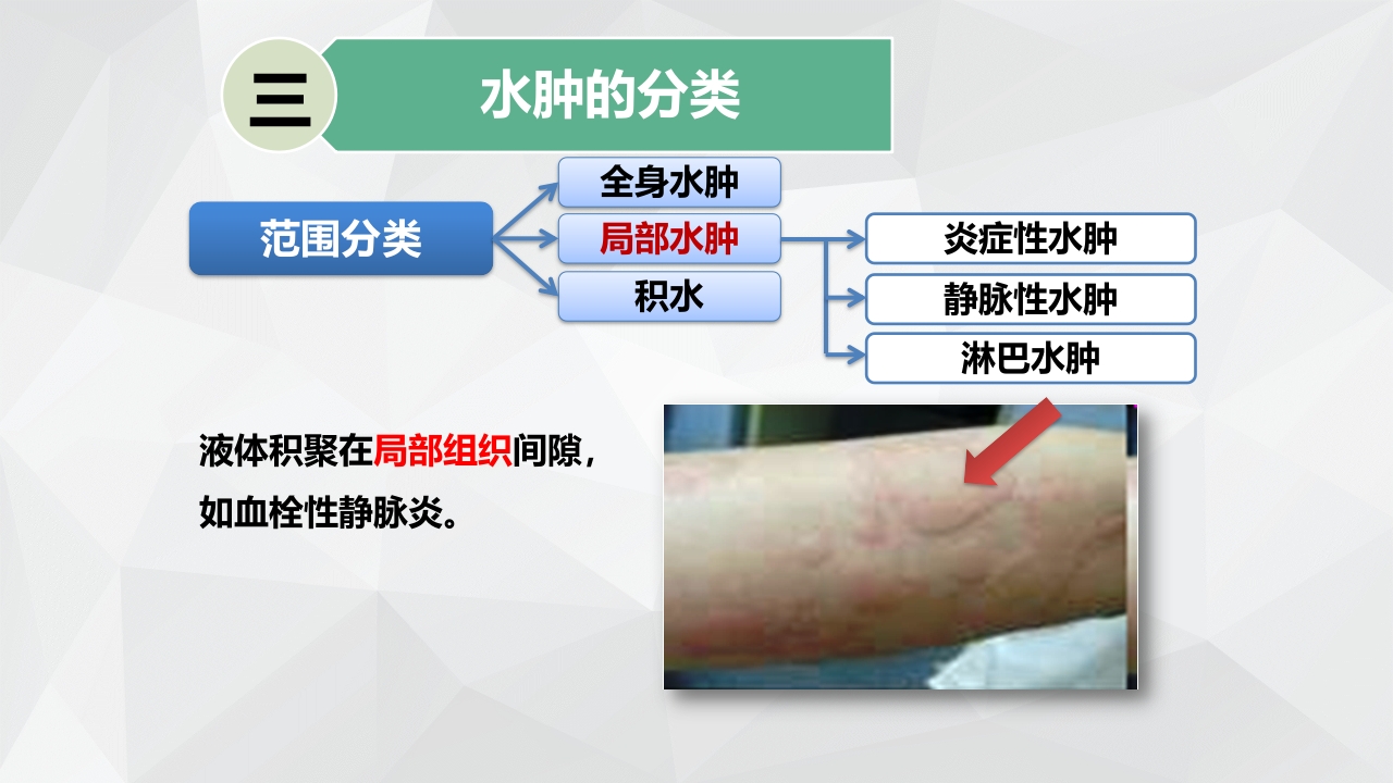 水肿的分类及护理PPT课件下载10