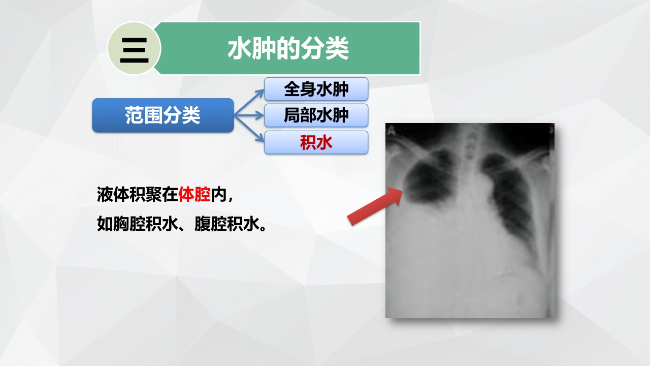 水肿的分类及护理PPT课件下载11