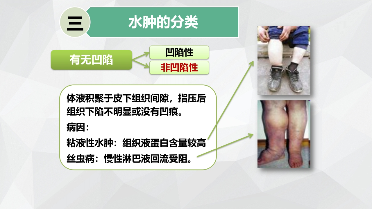 水肿的分类及护理PPT课件下载13