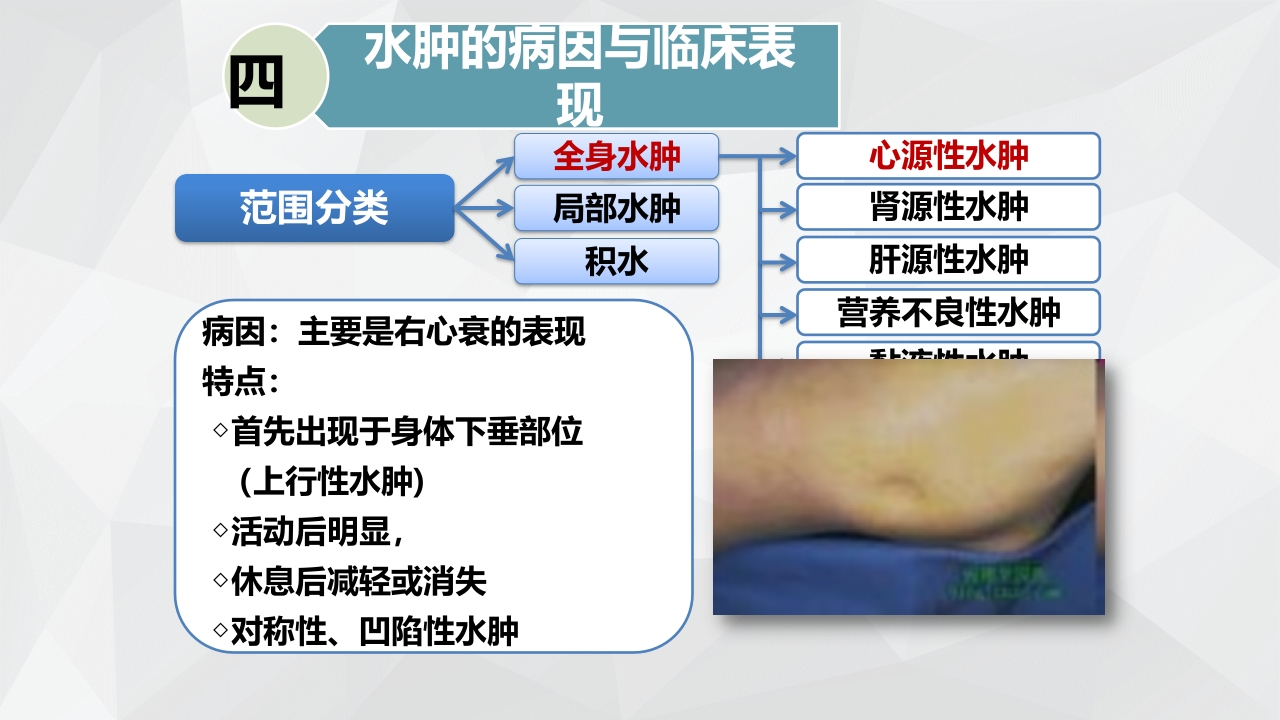 水肿的分类及护理PPT课件下载15