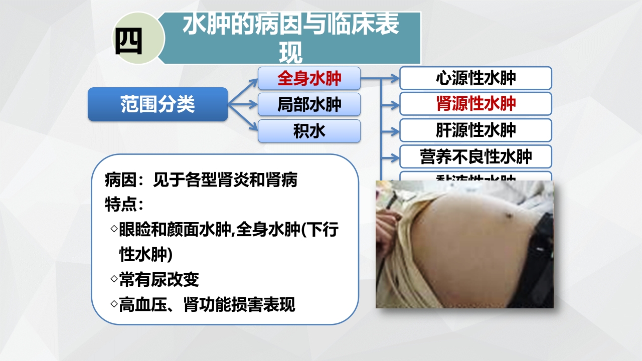 水肿的分类及护理PPT课件下载16