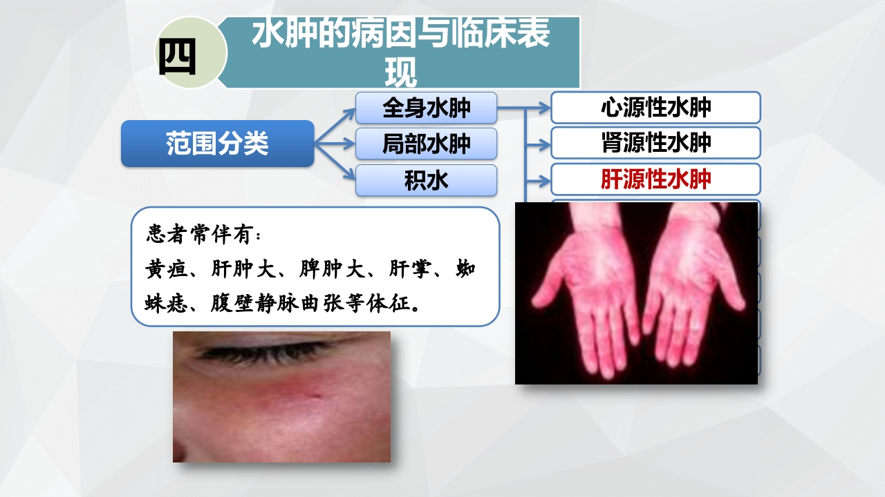 水肿的分类及护理PPT课件下载19