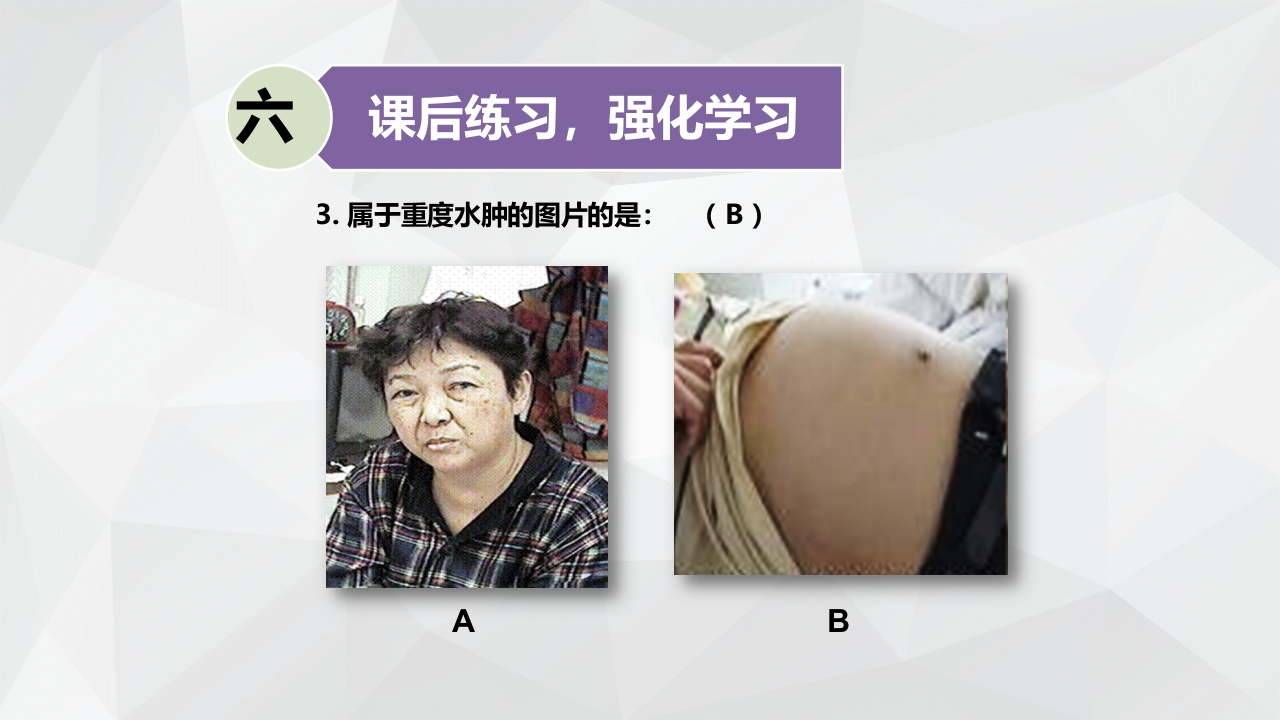 水肿的分类及护理PPT课件下载32