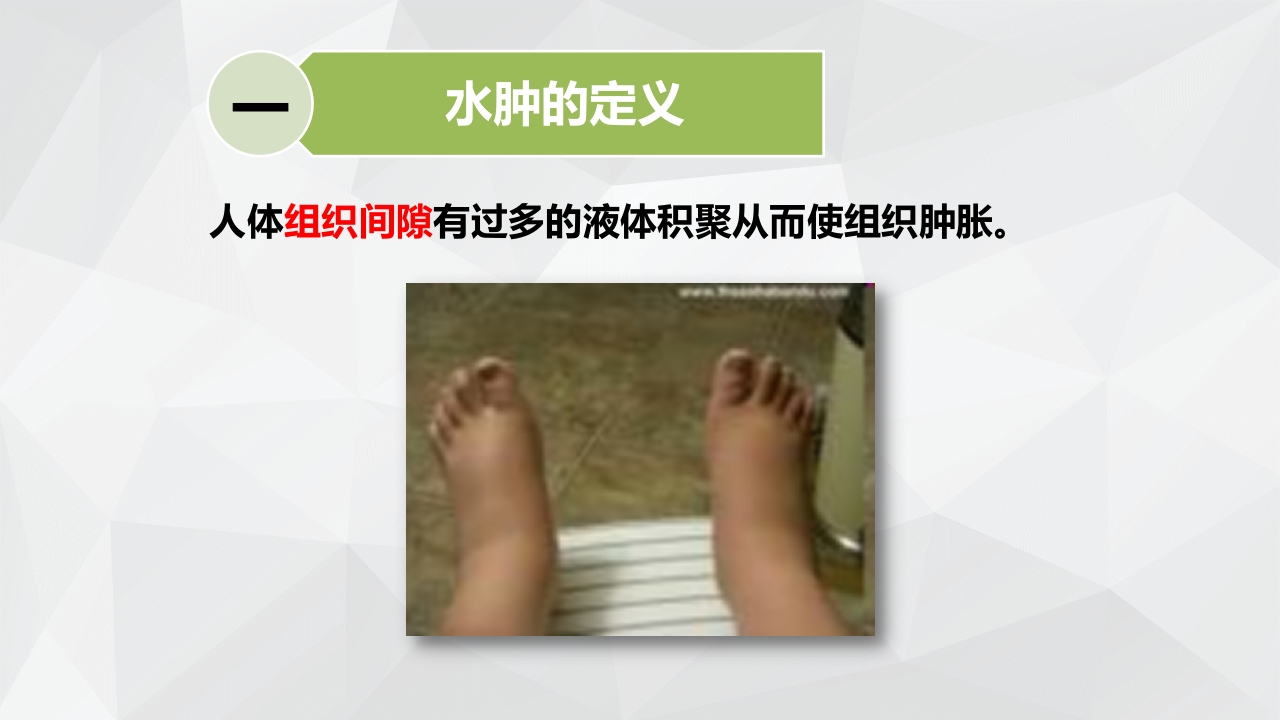 水肿的分类及护理PPT课件下载5