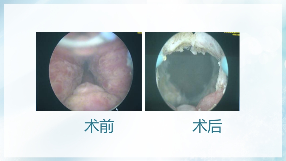 前列腺增生症的治疗及护理PPT课件16