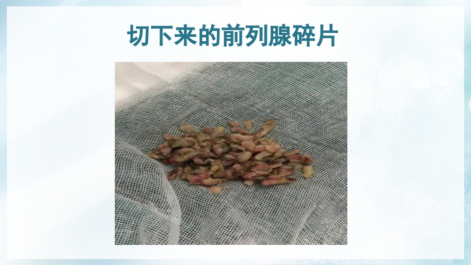 前列腺增生症的治疗及护理PPT课件17