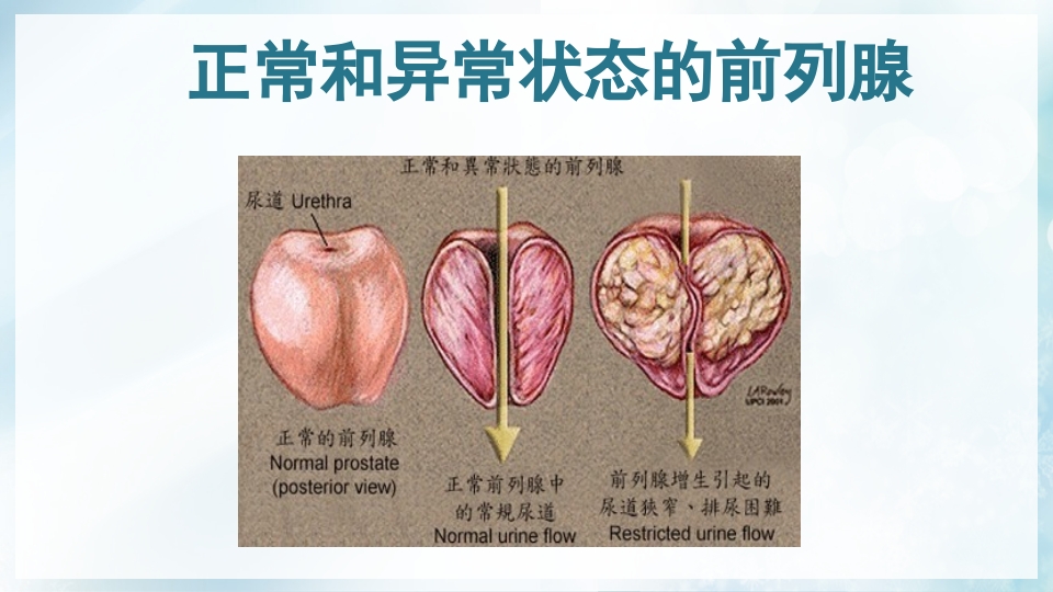 前列腺增生症的治疗及护理PPT课件4