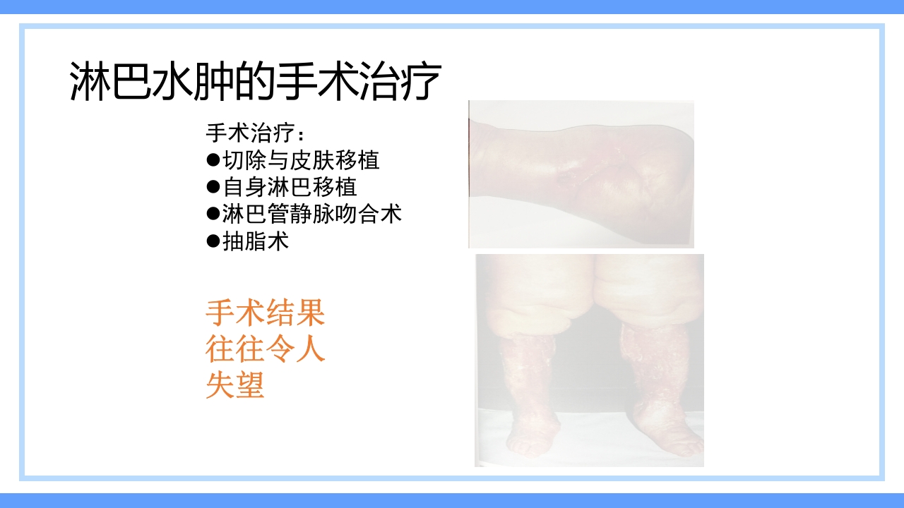 淋巴水肿及CDT标准化治疗PPT课件下载13