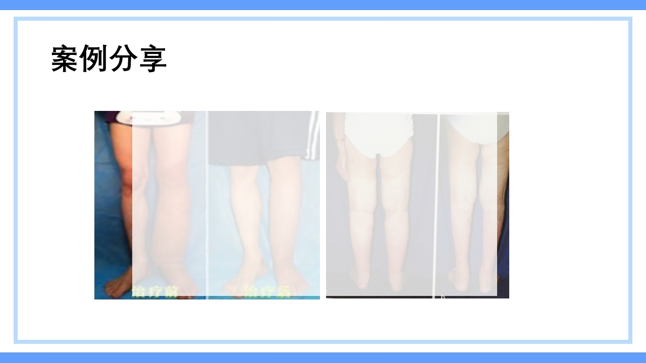 淋巴水肿及CDT标准化治疗PPT课件下载34