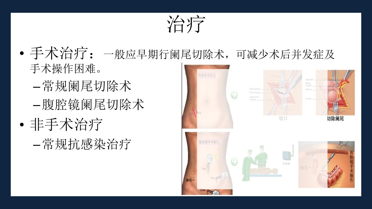 急性化脓性阑尾炎PPT课件13