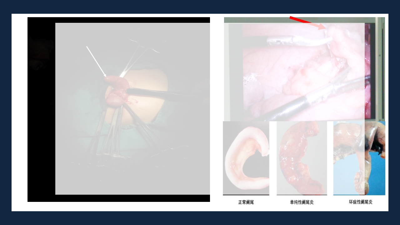 急性化脓性阑尾炎PPT课件14