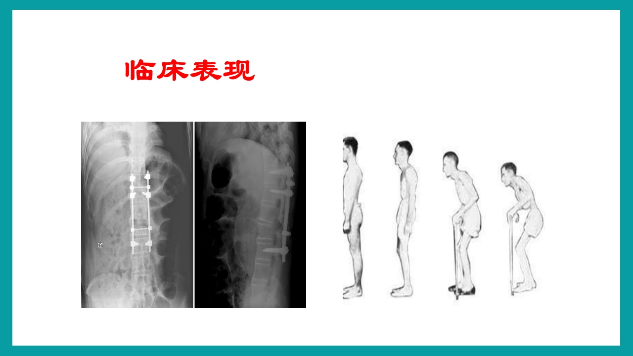 强直性脊柱炎护理查房PPT课件11