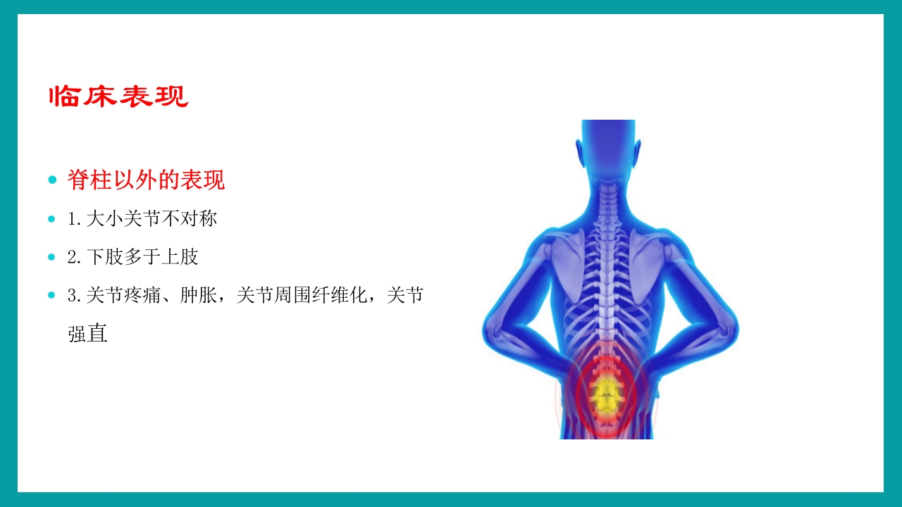强直性脊柱炎护理查房PPT课件12