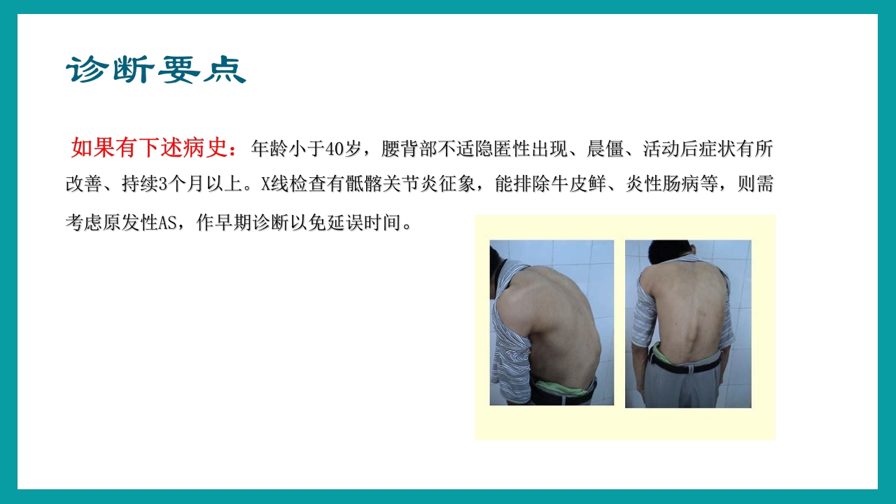 强直性脊柱炎护理查房PPT课件16