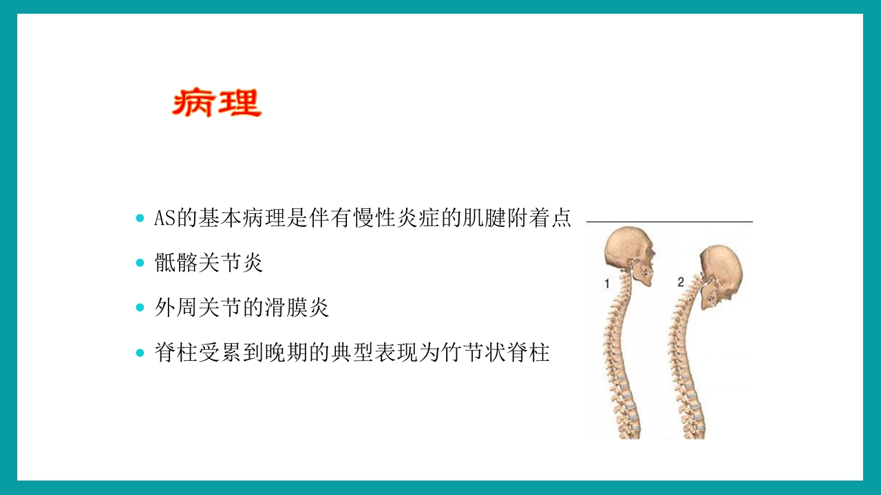 强直性脊柱炎护理查房PPT课件9