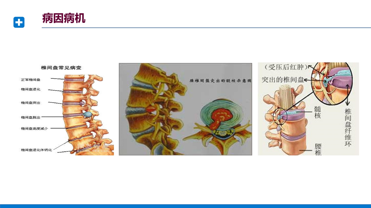 腰椎间盘突出症诊断与治疗PPT课件下载18