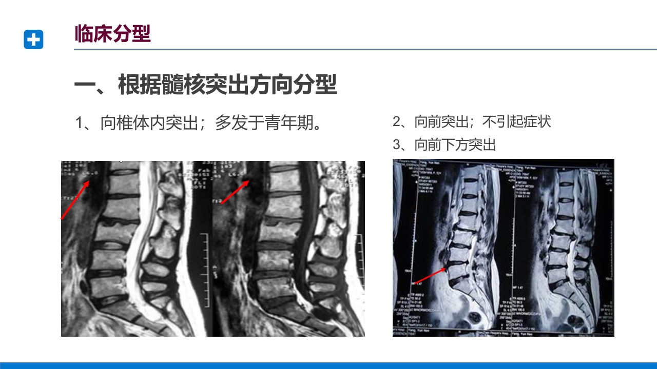 腰椎间盘突出症诊断与治疗PPT课件下载20