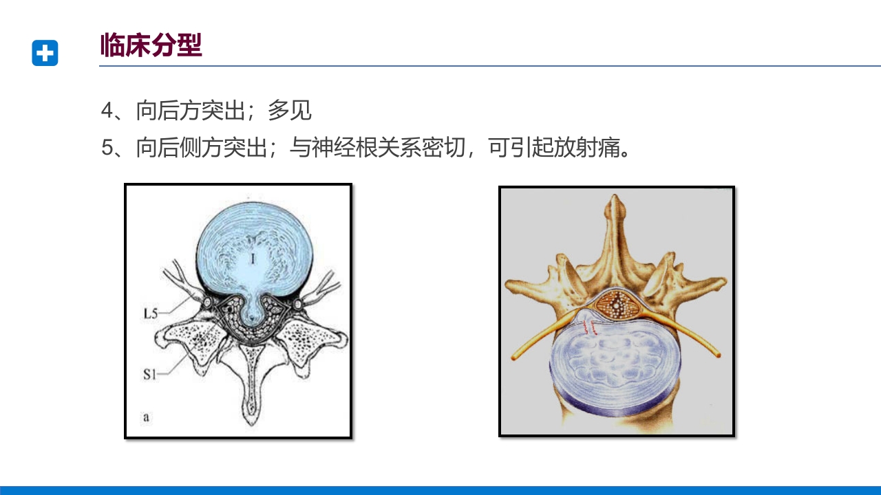 腰椎间盘突出症诊断与治疗PPT课件下载21