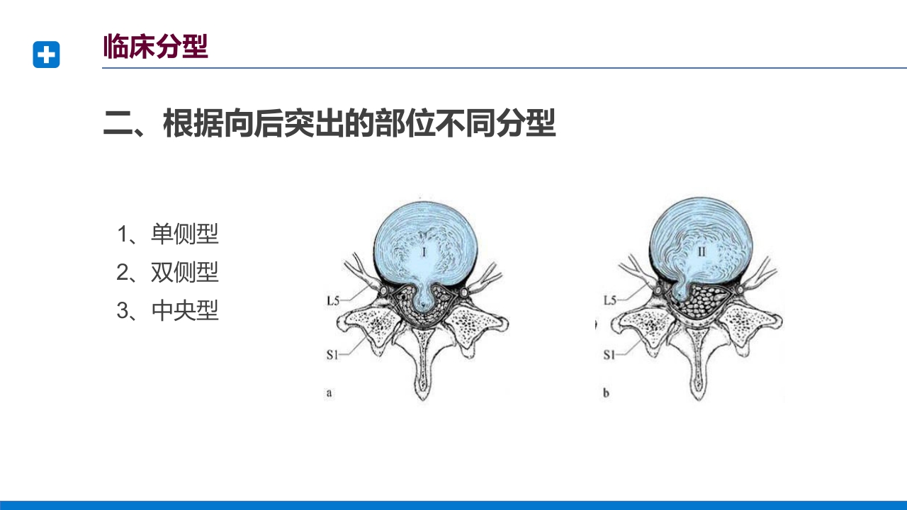 腰椎间盘突出症诊断与治疗PPT课件下载22
