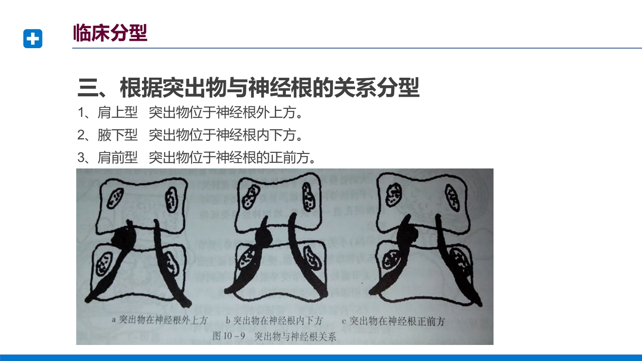 腰椎间盘突出症诊断与治疗PPT课件下载23