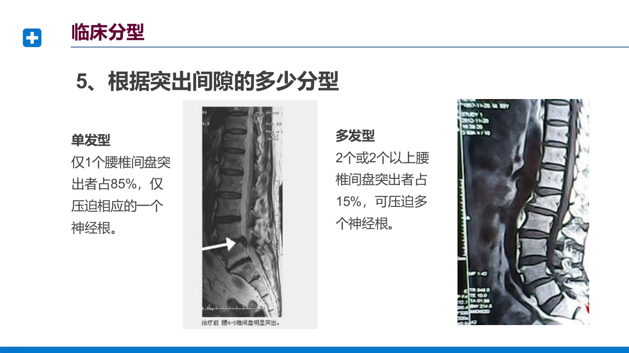 腰椎间盘突出症诊断与治疗PPT课件下载25