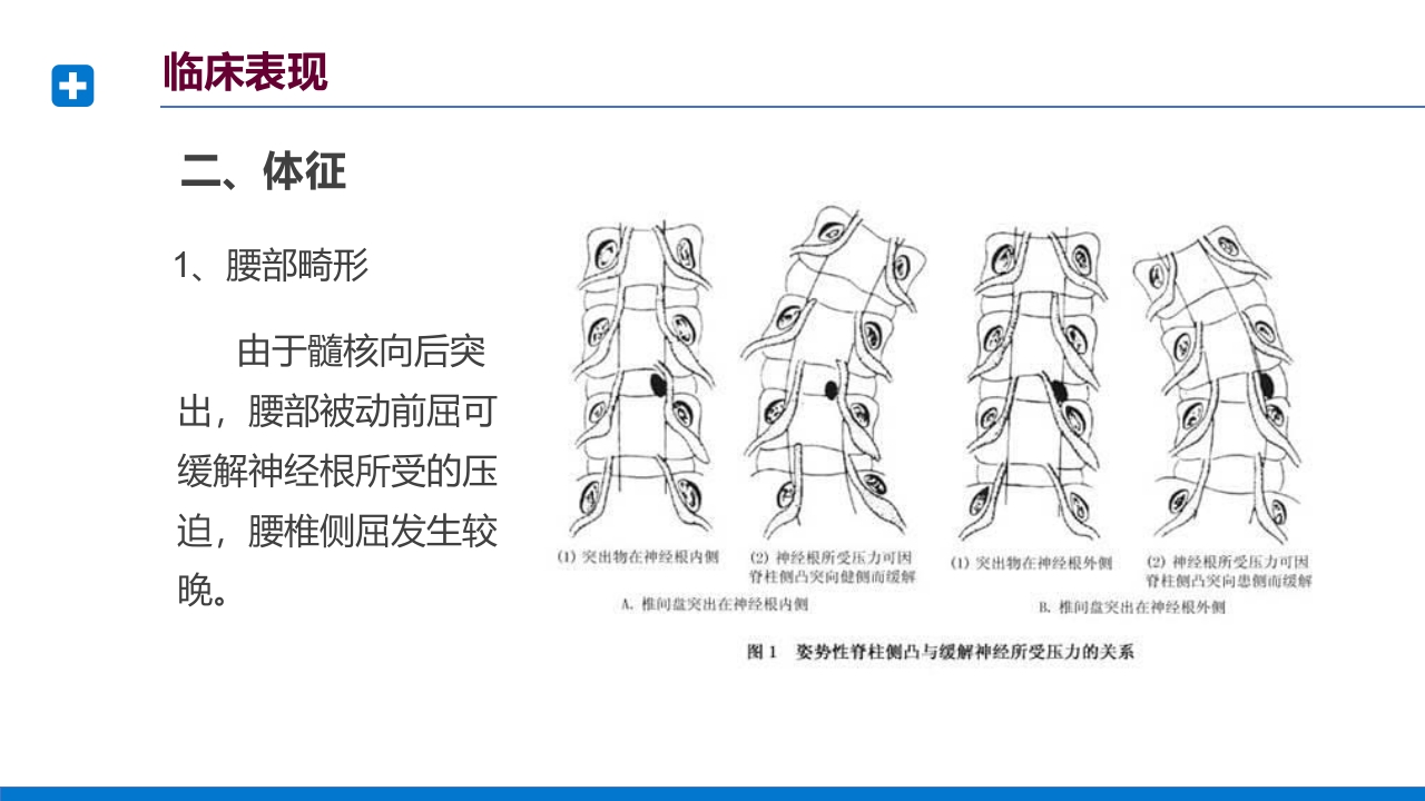腰椎间盘突出症诊断与治疗PPT课件下载30