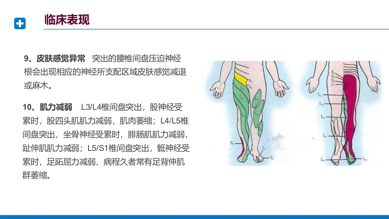 腰椎间盘突出症诊断与治疗PPT课件下载35