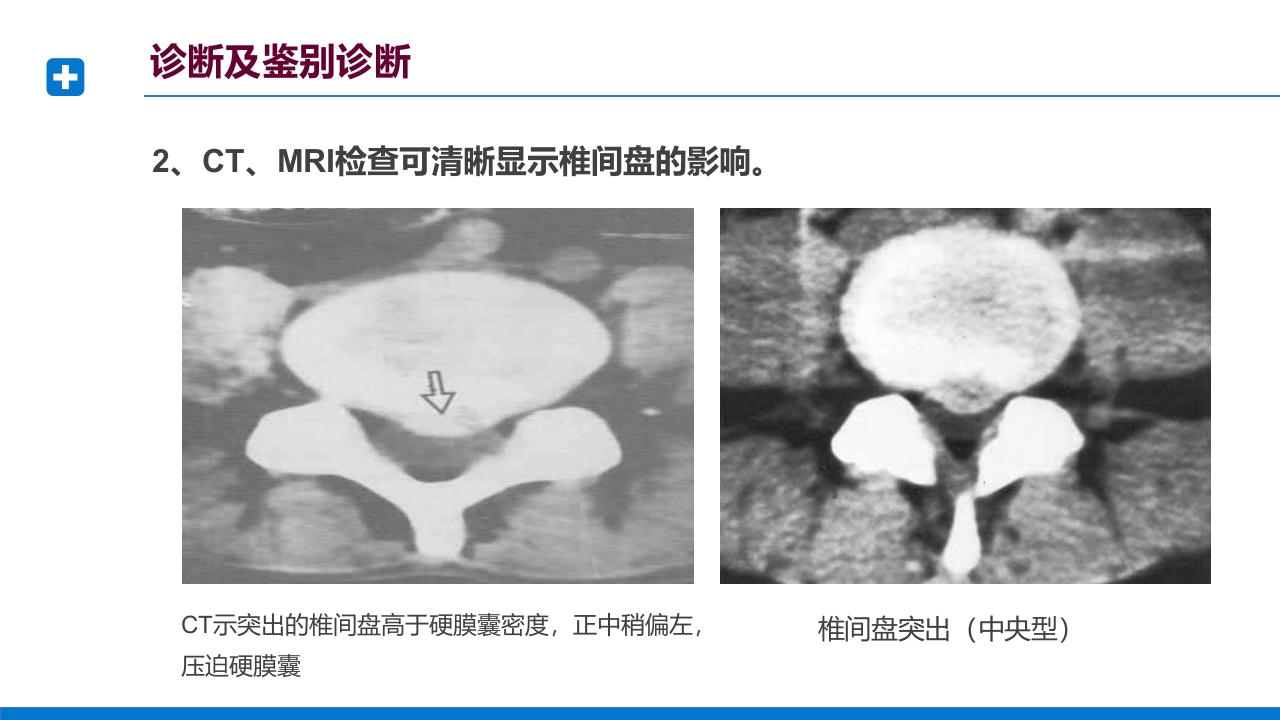 腰椎间盘突出症诊断与治疗PPT课件下载39