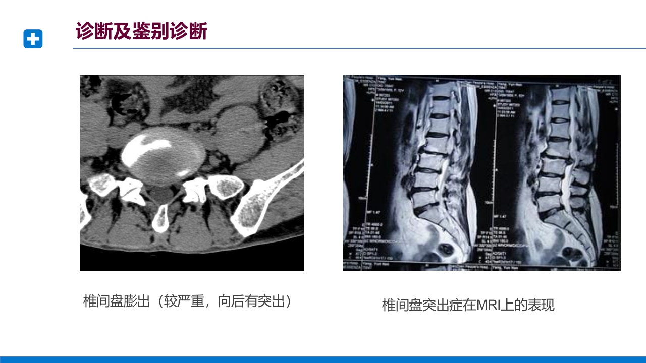 腰椎间盘突出症诊断与治疗PPT课件下载40